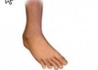 Enfermedades de los pies | Recurso educativo 45754
