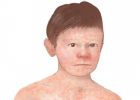 Description of measles | Recurso educativo 677284