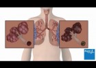 The effects of smoking on your body | Recurso educativo 726054