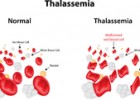 Beta-Thalassemia | Recurso educativo 747318